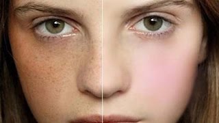 Beauty Secrets - How To Treat Pigmentation And Freckles In 1 Month.